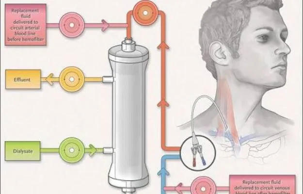 CRRT continuous renal replacement therapy in Hyderabad