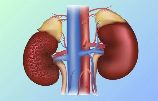 Diabetes related kidney diseases treatment in Hyderabad by Dr. Ramesh Vasa