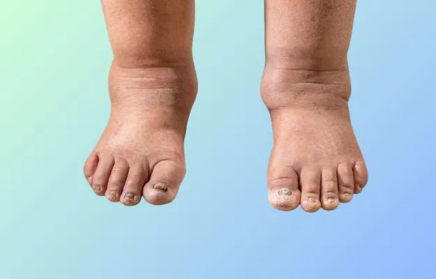Edema (swelling of feet and face) kidney-related care in Hyderabad