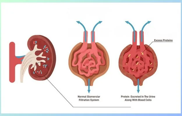 Glomerular diseases treatment in Hyderabad by Dr. Ramesh Vasa