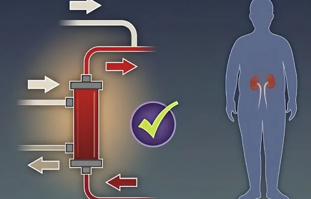 Hemodiafiltration (HDF) treatment in Hyderabad