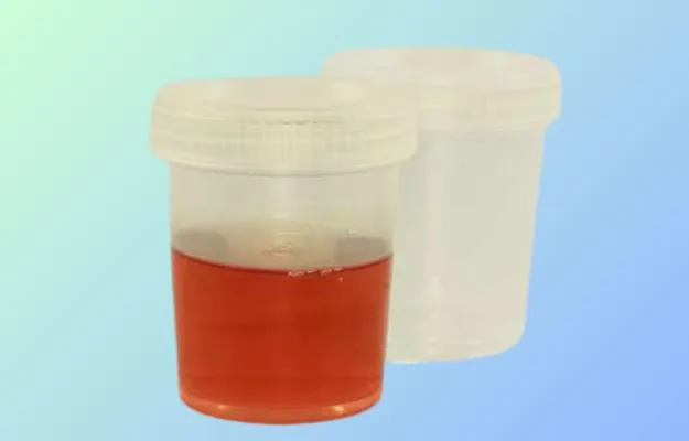Hematuria (blood in urine) evaluation in Hyderabad