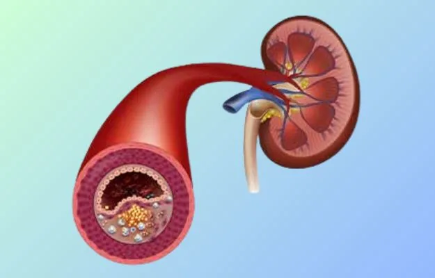 Hypertension and hypertension-related kidney diseases treatment in Hyderabad