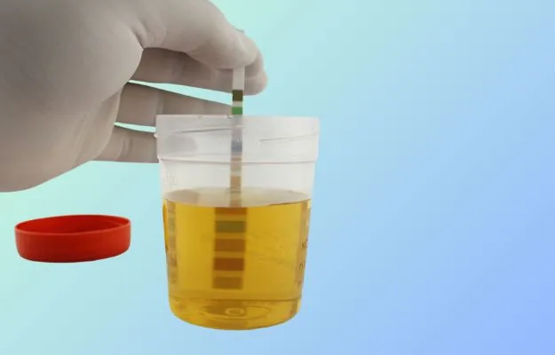 Proteinuria (protein in urine) evaluation in Hyderabad